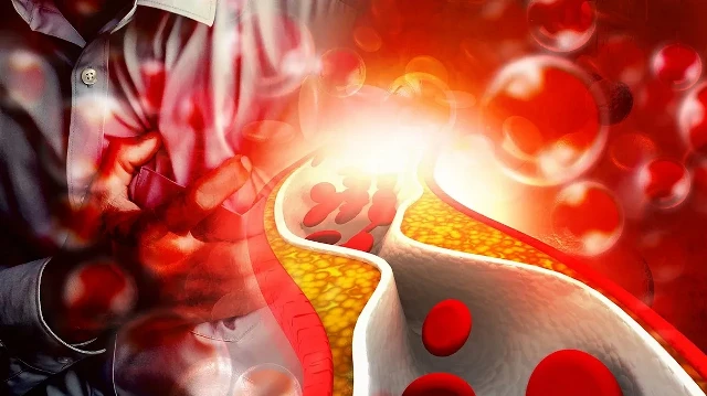 uzmanindan uyari yuksek ldl kalp krizi ve inme riskini artiriyor q7xKqegw